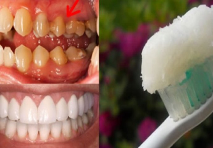 You are currently viewing TAKO LAKO: Ova jedinstvena pasta može ukloniti KAMENAC sa zuba za samo NEKOLIKO DANA!